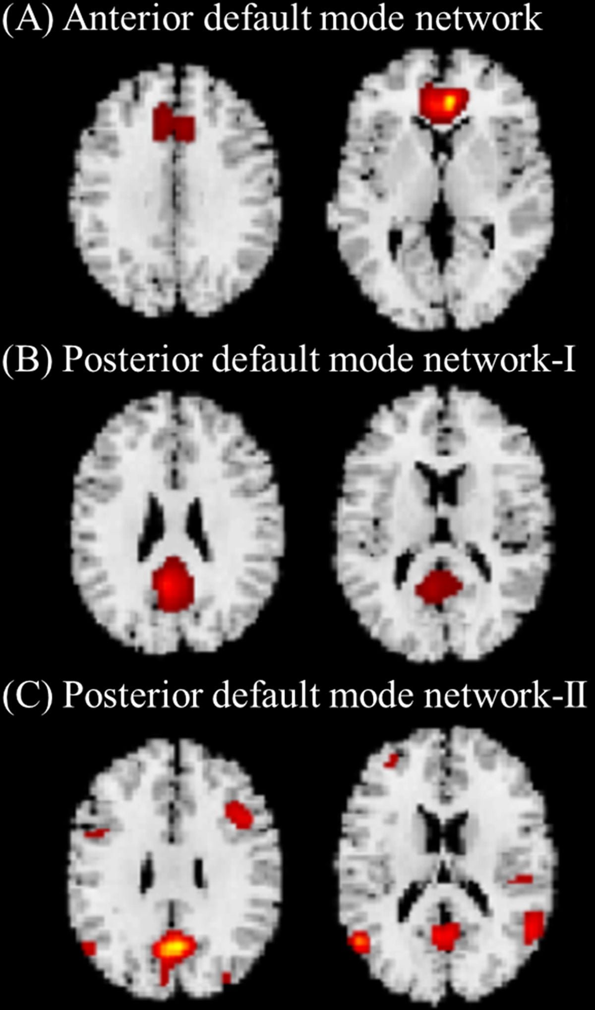 Three gray matter (GM) structural networks related to the default mode network (DMN). Three GM structural networks related to DMN that were identified are shown. (A) anterior DMN; (B) posterior DMN-I, including the posterior cingulate cortex (PCC) and precuneus; and (C) posterior DMN-II, including the PCC, precuneus, inferior parietal cortex, and lateral temporal cortices