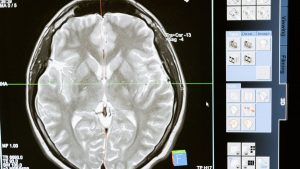 Intricate MRI brain scan displayed on a computer screen for medical analysis and diagnosis