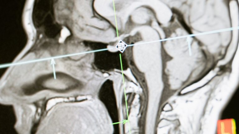 Close-up of an MRI scan showing a sagittal view of the human brain for analysis